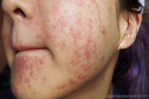 Skin Care ဓာတ်မတည့်ခြင်းကြောင့် မျက်နှာအသားအရေ ပျက်စီးခြင်းအတွက် အိမ်တွင်းကုထုံးများ